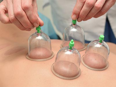 Cupping Therapy